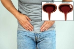 Bladder Cancer experts, Bladder Cancer, why is bladder cancer common in men, Cigarette