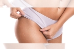 how to get rid of red stretch marks, red and white stretch marks, difference between red and white stretch marks explained and it s natural to have them, Stretch marks