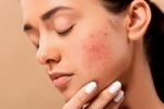 acne, pimples, 10 ways to get rid of pimples at home, Unsc
